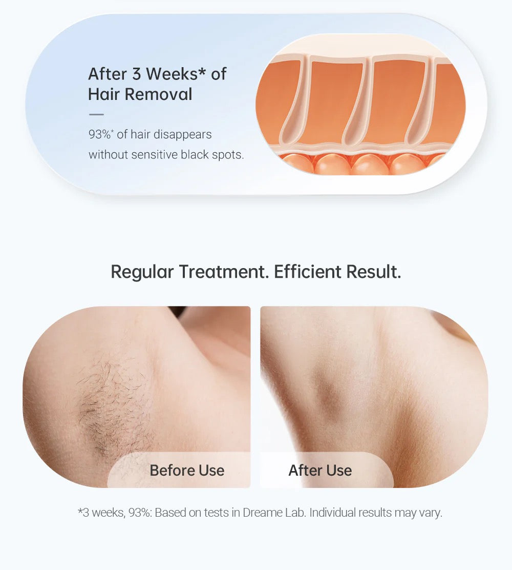 Dreame - Hair Removal Dreame - Hair Removal